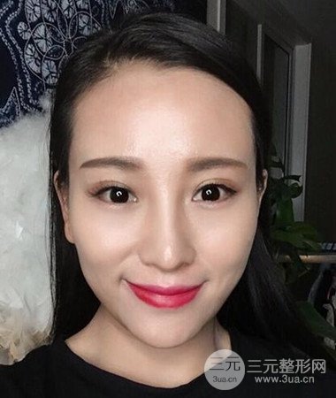 內(nèi)切微創(chuàng)去眼袋手術(shù)案例分享，附上手術(shù)恢復(fù)照片