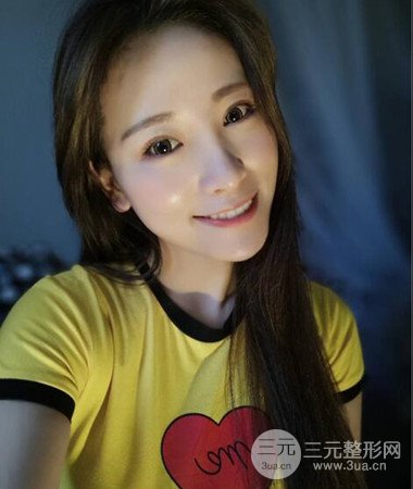 內(nèi)切微創(chuàng)去眼袋手術(shù)案例分享，附上手術(shù)恢復(fù)照片