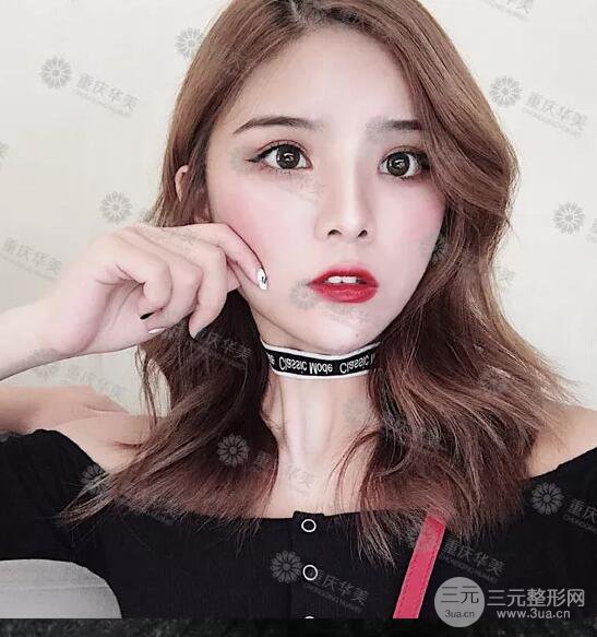 重慶萬(wàn)州華美雙眼皮+內(nèi)眼角