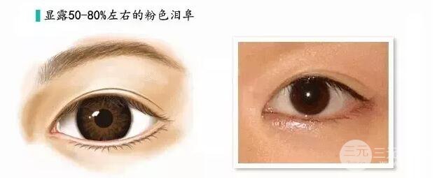 重慶萬(wàn)州華美雙眼皮+內(nèi)眼角