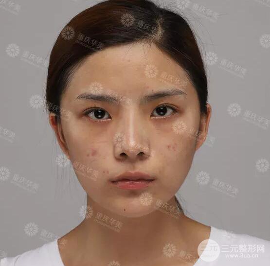 重慶萬(wàn)州華美雙眼皮+內(nèi)眼角