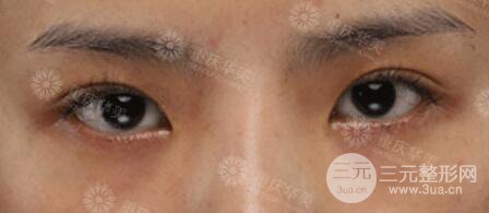 重慶萬(wàn)州華美雙眼皮+內(nèi)眼角