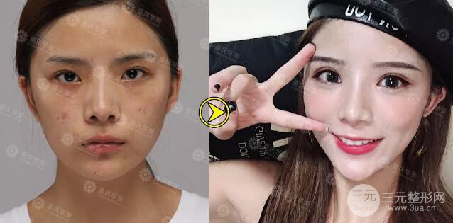 重慶萬(wàn)州華美雙眼皮+內(nèi)眼角