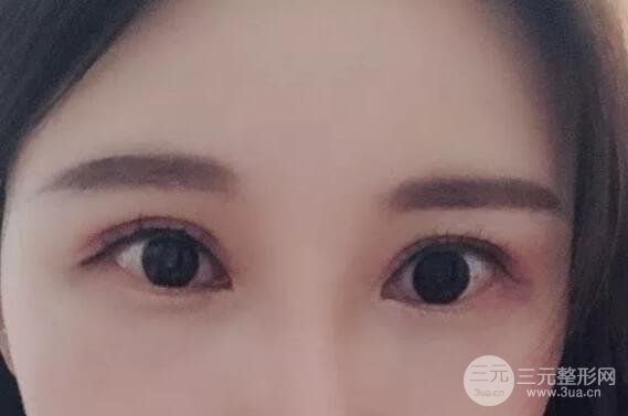 蘭大二院張選奮怎么樣?雙眼皮修復案例前后對比圖