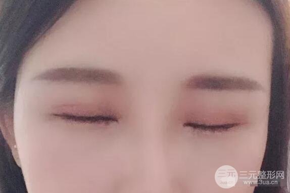 蘭大二院張選奮怎么樣?雙眼皮修復案例前后對比圖
