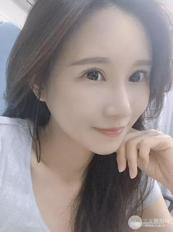 蘭大二院張選奮怎么樣?雙眼皮修復案例前后對比圖