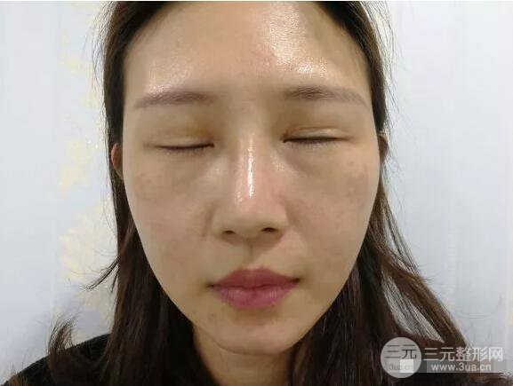 蘭大二院張選奮怎么樣?雙眼皮修復案例前后對比圖