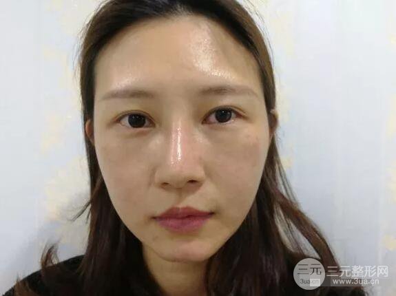 蘭大二院張選奮怎么樣?雙眼皮修復案例前后對比圖