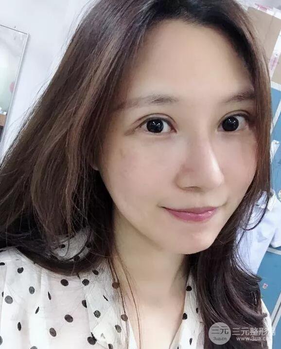 蘭大二院張選奮怎么樣?雙眼皮修復案例前后對比圖