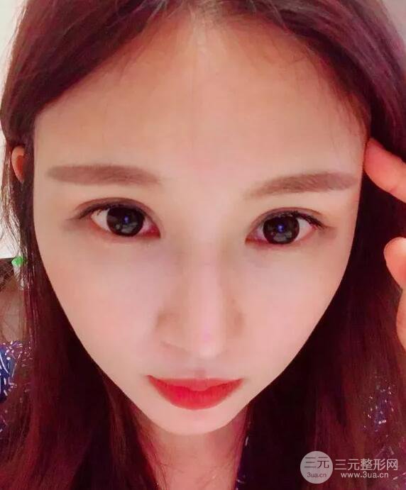 蘭大二院張選奮怎么樣?雙眼皮修復案例前后對比圖