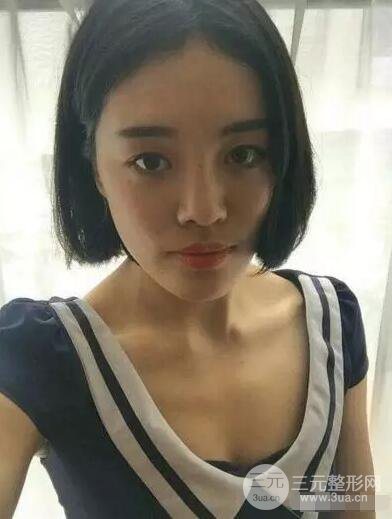 成都玉之光自體脂肪面部填充劉中國真人案例反饋|內(nèi)附對比前后照