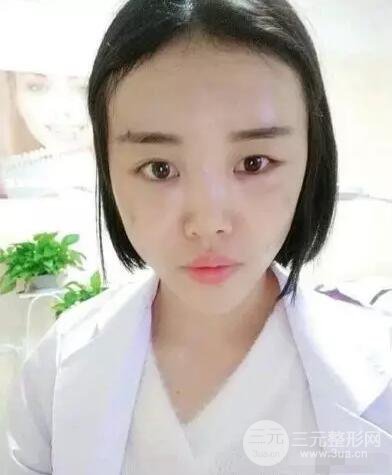 成都玉之光自體脂肪面部填充劉中國真人案例反饋|內(nèi)附對比前后照