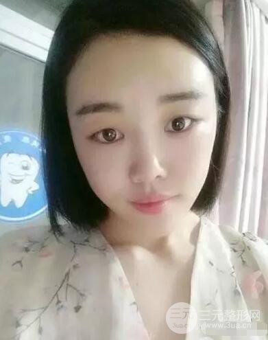 成都玉之光自體脂肪面部填充劉中國真人案例反饋|內(nèi)附對比前后照