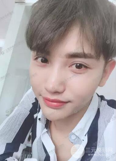 上海華美楊亞益全切雙眼皮案例對比圖 男女雙眼皮案例混搭