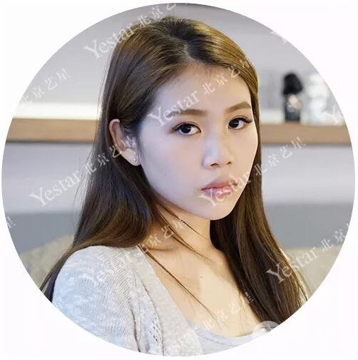 北京藝星仇侃敏耳軟骨隆鼻恢復(fù)過程|內(nèi)附前后對比圖