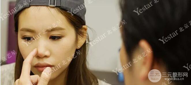 北京藝星仇侃敏耳軟骨隆鼻恢復(fù)過程|內(nèi)附前后對比圖