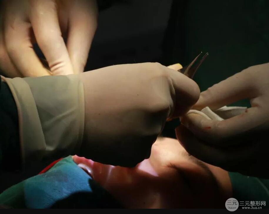 北京藝星仇侃敏耳軟骨隆鼻恢復(fù)過程|內(nèi)附前后對比圖