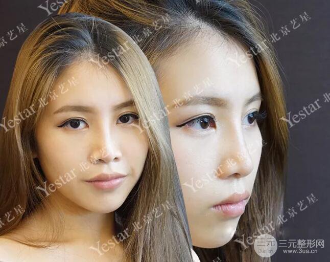 北京藝星仇侃敏耳軟骨隆鼻恢復(fù)過程|內(nèi)附前后對比圖