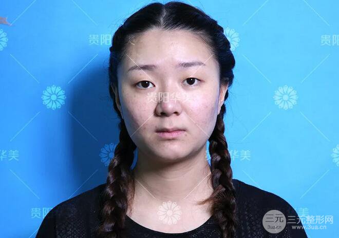 貴陽華美郭宗科全切雙眼皮+假體隆鼻案例前后對比圖 華美員工全臉整形實錄
