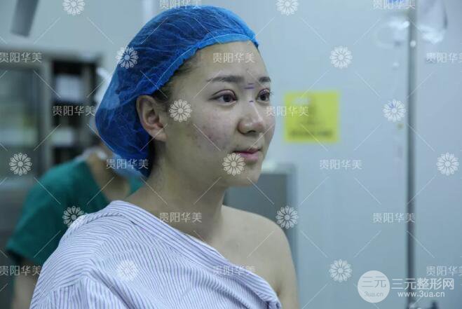 貴陽華美郭宗科全切雙眼皮+假體隆鼻案例前后對比圖 華美員工全臉整形實錄