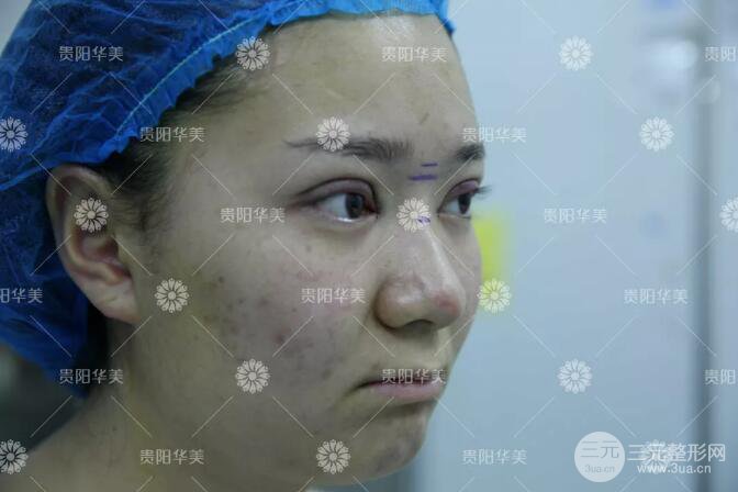 貴陽華美郭宗科全切雙眼皮+假體隆鼻案例前后對比圖 華美員工全臉整形實錄