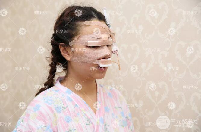 貴陽華美郭宗科全切雙眼皮+假體隆鼻案例前后對比圖 華美員工全臉整形實錄