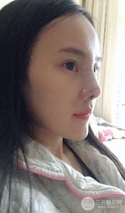 成都大華隆鼻怎么樣?真實案例前后對比圖記錄恢復過程