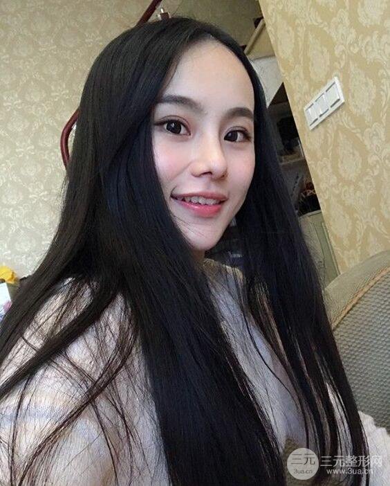 成都大華隆鼻怎么樣?真實案例前后對比圖記錄恢復過程