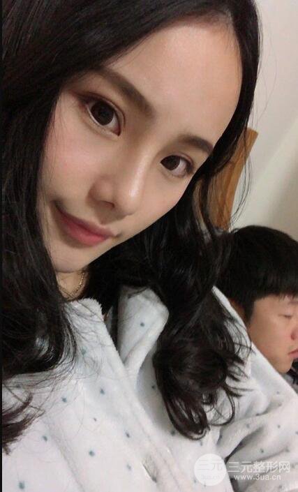 成都大華隆鼻怎么樣?真實案例前后對比圖記錄恢復過程