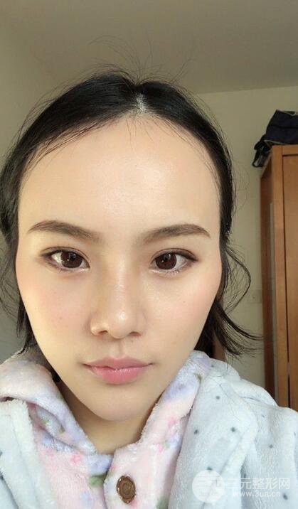 成都大華隆鼻怎么樣?真實案例前后對比圖記錄恢復過程