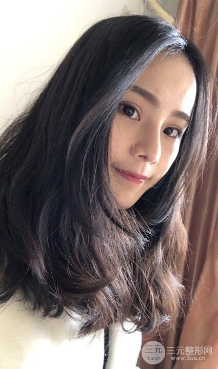 成都大華隆鼻怎么樣?真實案例前后對比圖記錄恢復過程