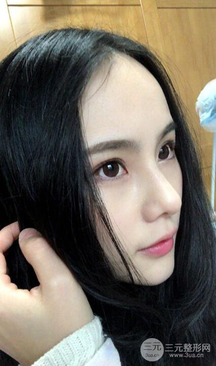 成都大華隆鼻怎么樣?真實案例前后對比圖記錄恢復過程