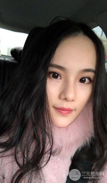 成都大華隆鼻怎么樣?真實案例前后對比圖記錄恢復過程