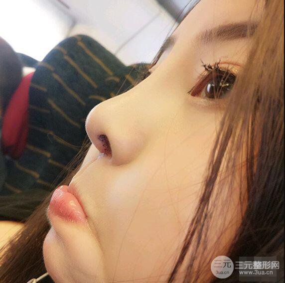 合肥壹加壹甘泉涌軟骨隆鼻前后對比圖|內(nèi)附真人案例恢復(fù)前過程