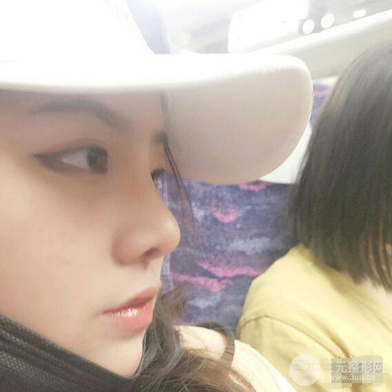 合肥壹加壹甘泉涌軟骨隆鼻前后對比圖|內(nèi)附真人案例恢復(fù)前過程