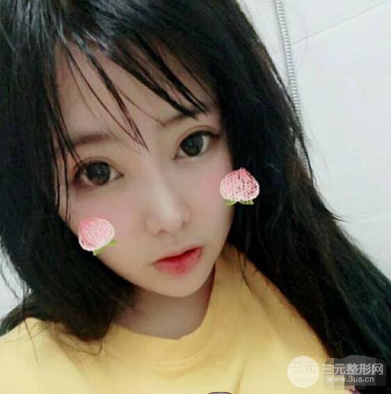 合肥壹加壹甘泉涌軟骨隆鼻前后對比圖|內(nèi)附真人案例恢復(fù)前過程