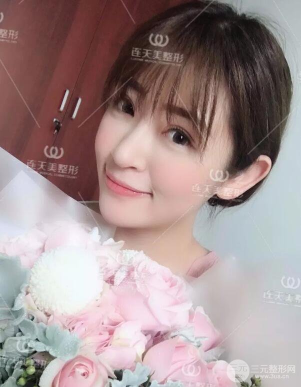 南京連天美整形周長兵隆鼻整形真人案例前后對比圖|內(nèi)附恢復過程心情日扎