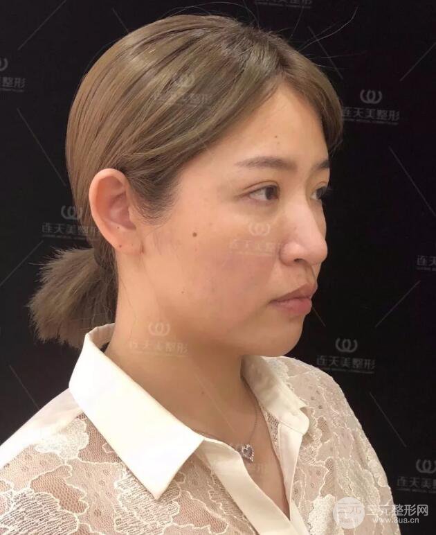 南京連天美整形周長兵隆鼻整形真人案例前后對比圖|內(nèi)附恢復過程心情日扎