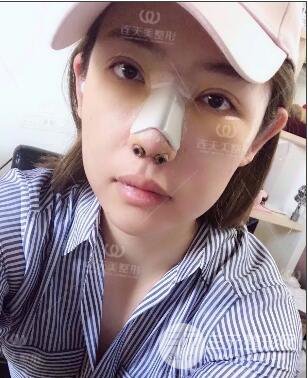 南京連天美整形周長兵隆鼻整形真人案例前后對比圖|內(nèi)附恢復過程心情日扎