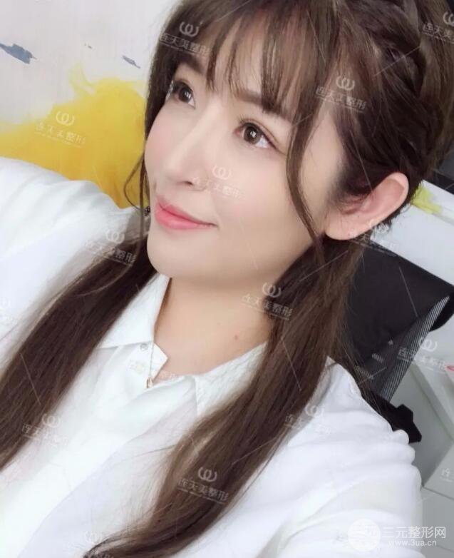 南京連天美整形周長兵隆鼻整形真人案例前后對比圖|內(nèi)附恢復過程心情日扎