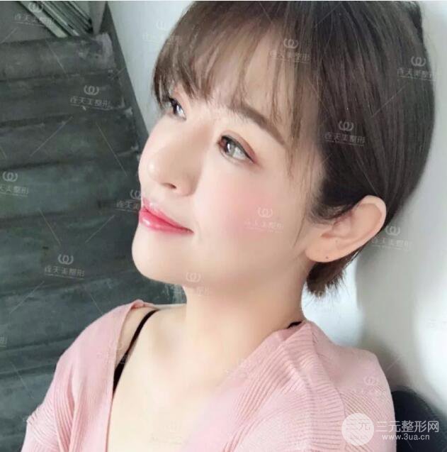 南京連天美整形周長兵隆鼻整形真人案例前后對比圖|內(nèi)附恢復過程心情日扎