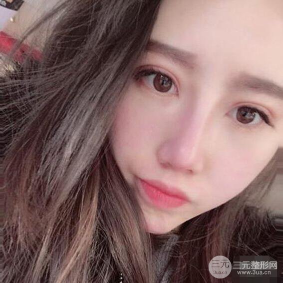北京聯(lián)合麗格吳焱秋耳軟骨隆鼻前后對比圖|塌鼻子的救星