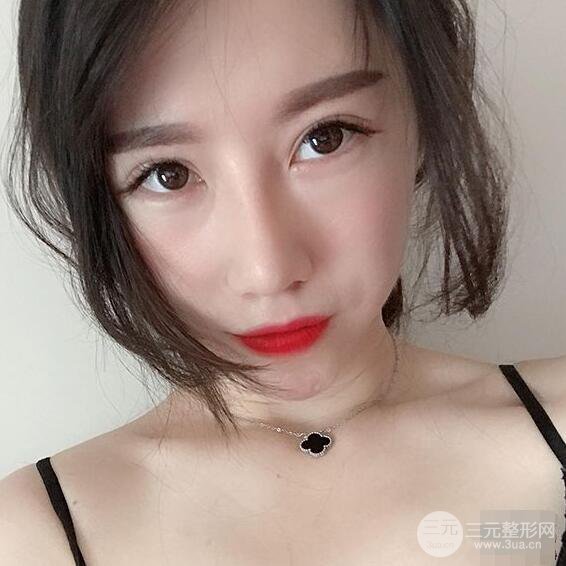 北京聯(lián)合麗格吳焱秋耳軟骨隆鼻前后對比圖|塌鼻子的救星