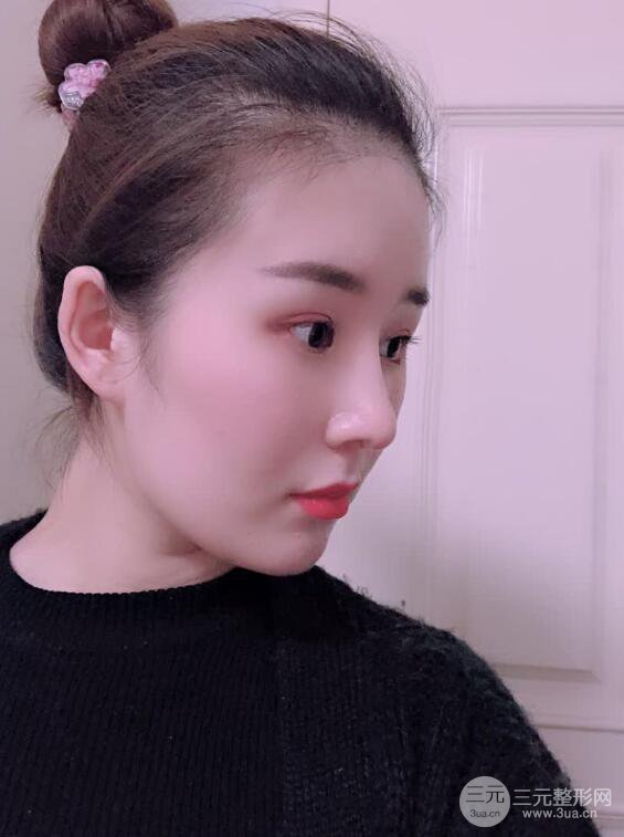 上海華美李庭勛膨體隆鼻前后對(duì)比圖一個(gè)月恢復(fù)心情日記