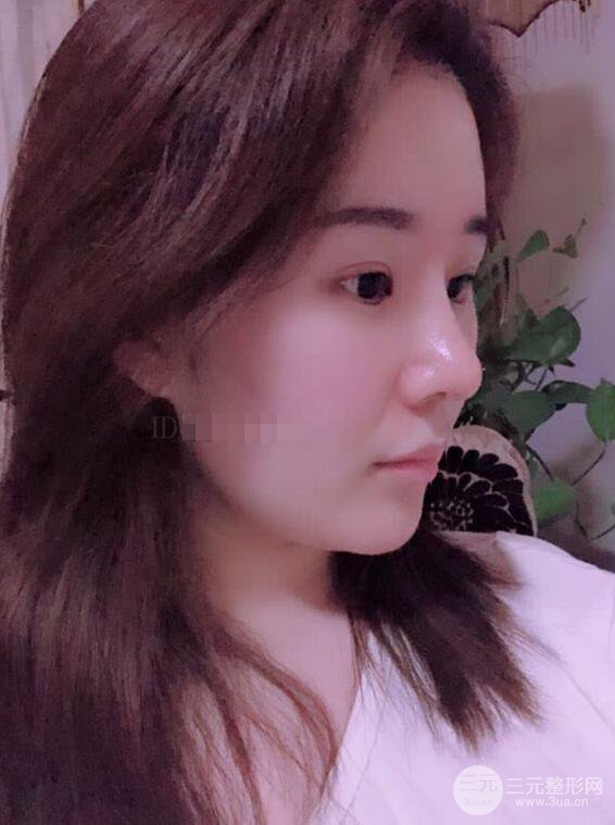 上海華美李庭勛膨體隆鼻前后對(duì)比圖一個(gè)月恢復(fù)心情日記