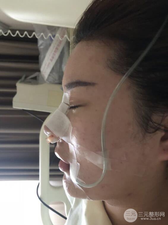 上海華美李庭勛膨體隆鼻前后對(duì)比圖一個(gè)月恢復(fù)心情日記