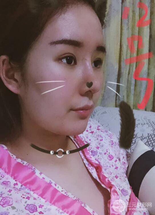 上海華美李庭勛膨體隆鼻前后對(duì)比圖一個(gè)月恢復(fù)心情日記