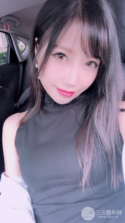 昆明華美美萊楊繼紅肋軟骨隆鼻前后對比圖恢復(fù)手札