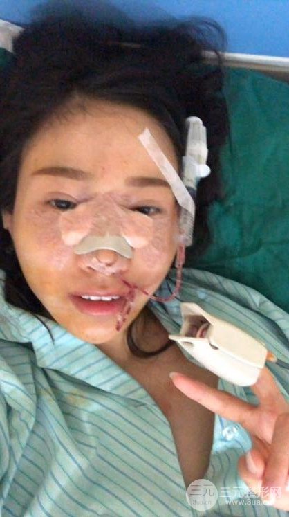 昆明華美美萊楊繼紅肋軟骨隆鼻前后對比圖恢復(fù)手札