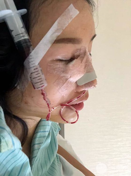 昆明華美美萊楊繼紅肋軟骨隆鼻前后對比圖恢復(fù)手札